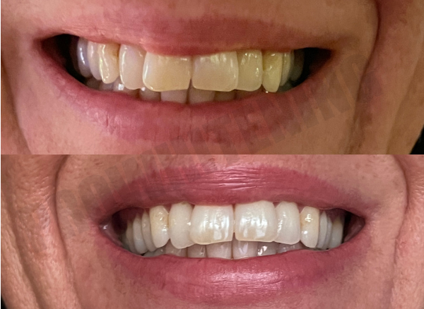 ProWhitening Strips