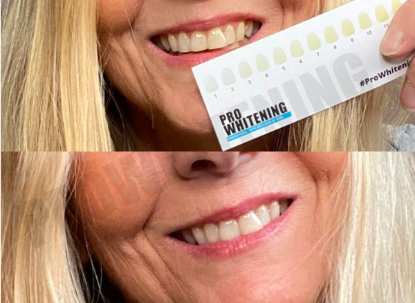 ProWhitening Strips